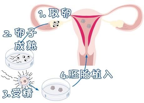 关于人工志愿者供卵咨询费用多少